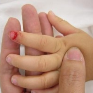 Trẻ bị dập ngón tay do sập cửa